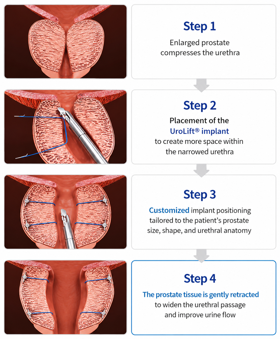 Progator before and after — enlarged prostate retracted from the urethra — Urogyn Busan