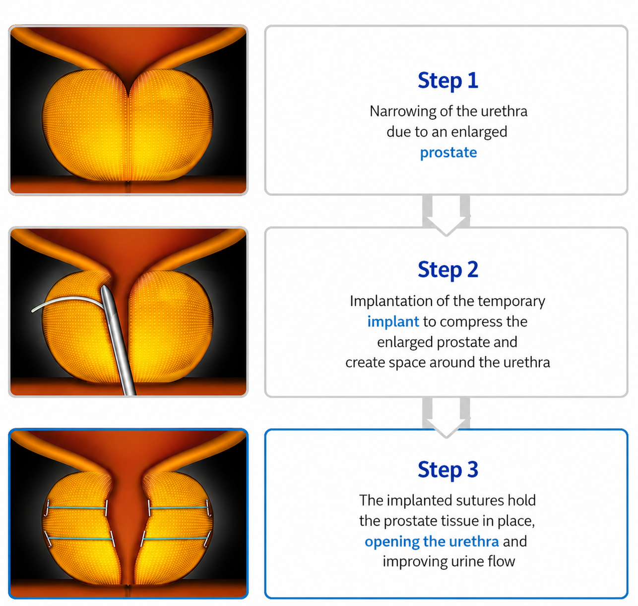 UroLift before and after — improved urine flow at Urogyn Busan