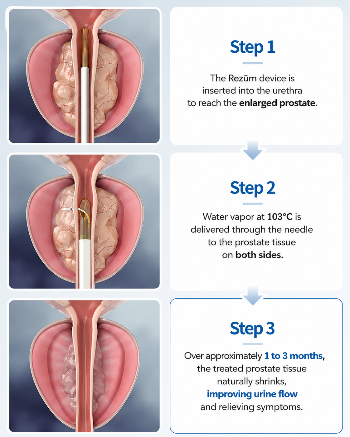 Rezum before and after — prostate volume reduced, urethra reopened — Urogyn Busan