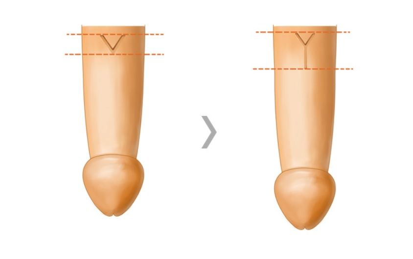 VY advancement flap surgical procedure at Urogyn Men's Clinic Busan Seomyeon
