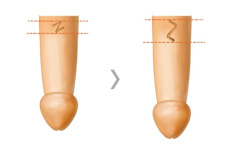 Z-plasty penile scar revision surgical procedure at Urogyn Men's Clinic Busan Seomyeon