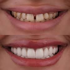 Before and after view of a smile, showing teeth before and after cosmetic dental work.