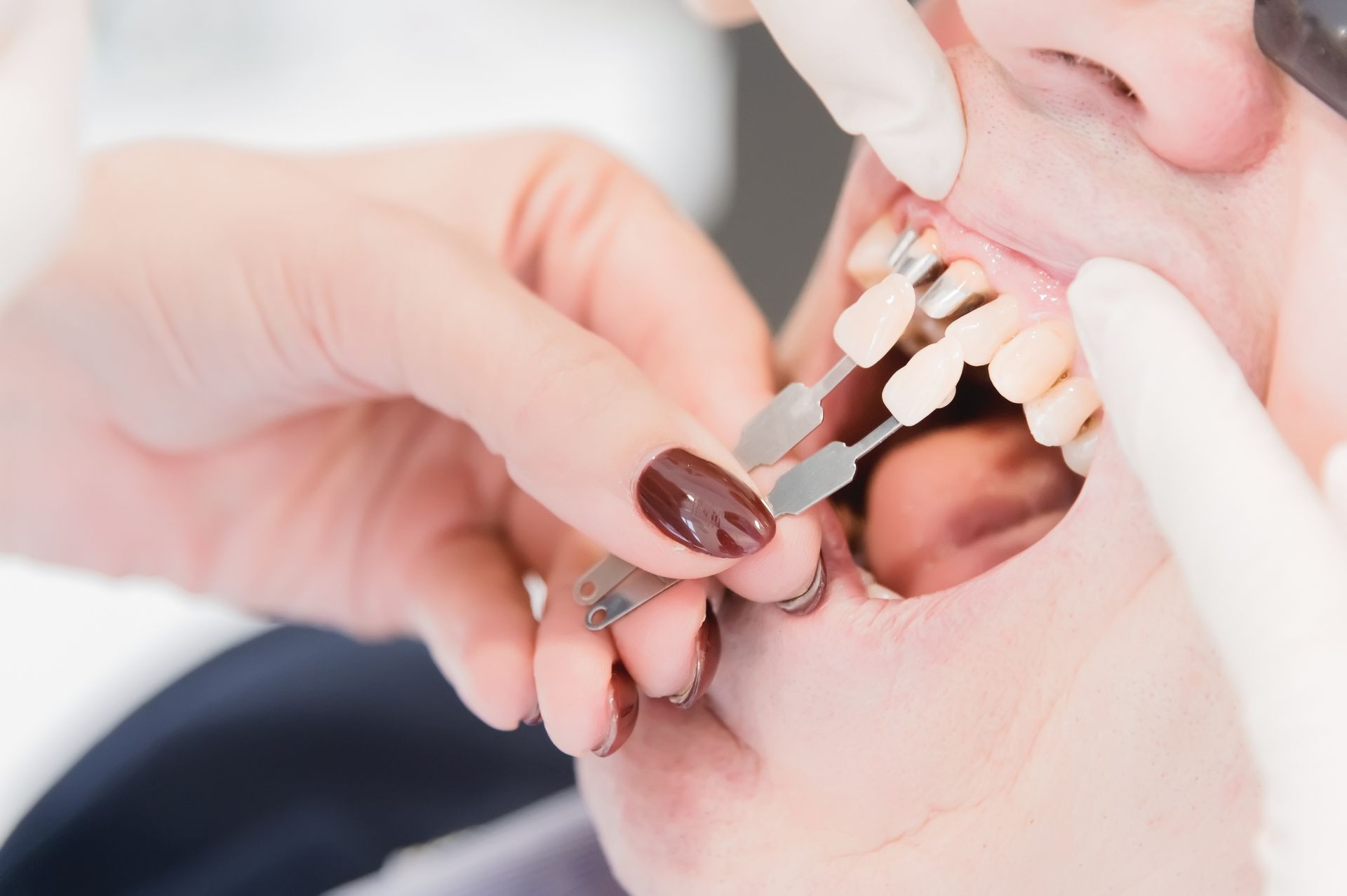 Dentist comparing tooth shade guide to patient's teeth during a procedure.