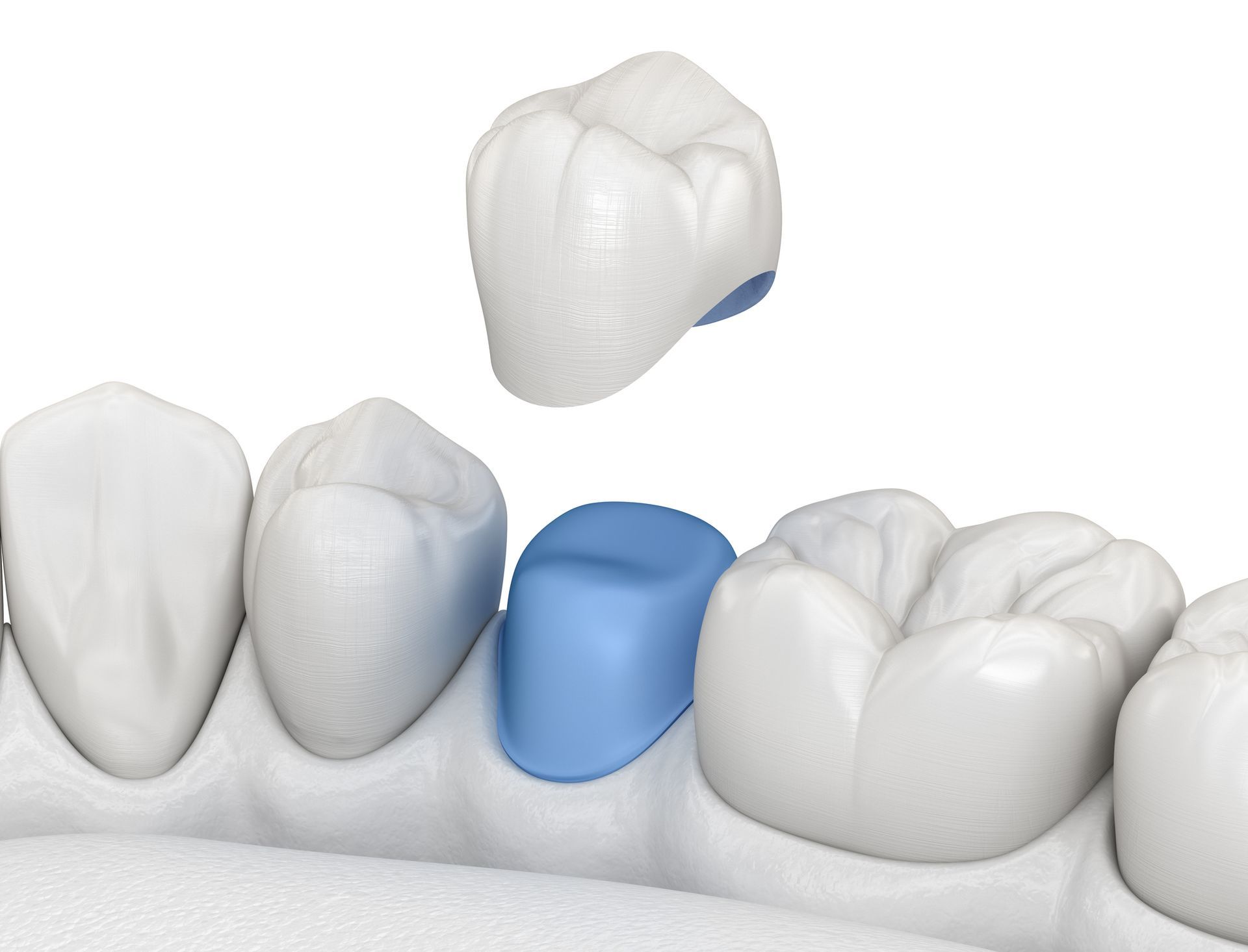 Teeth with blue and green dental treatments in a mouth, with a plastic retractor and rubber dam.