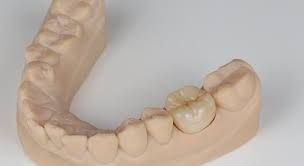 Dental cast with a single tooth crown in place. Beige colored cast with white background.