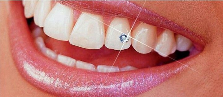 Close-up of a smiling mouth with bright white teeth and a sparkling jewel on one tooth. Shiny, pink lips.