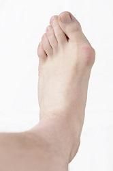 Foot with bunion.
