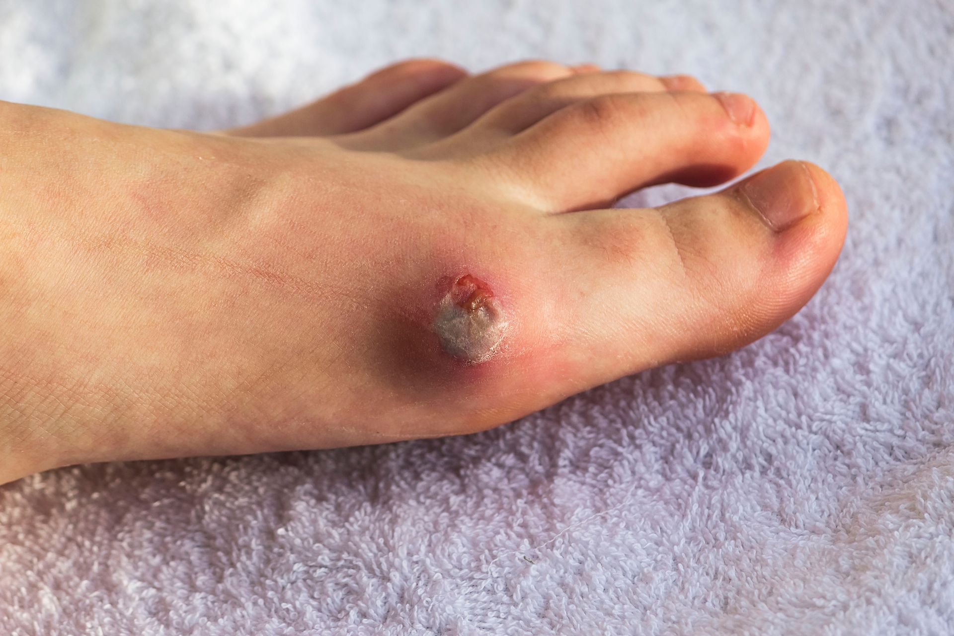 Foot with a red and blistered bunion on a white towel.