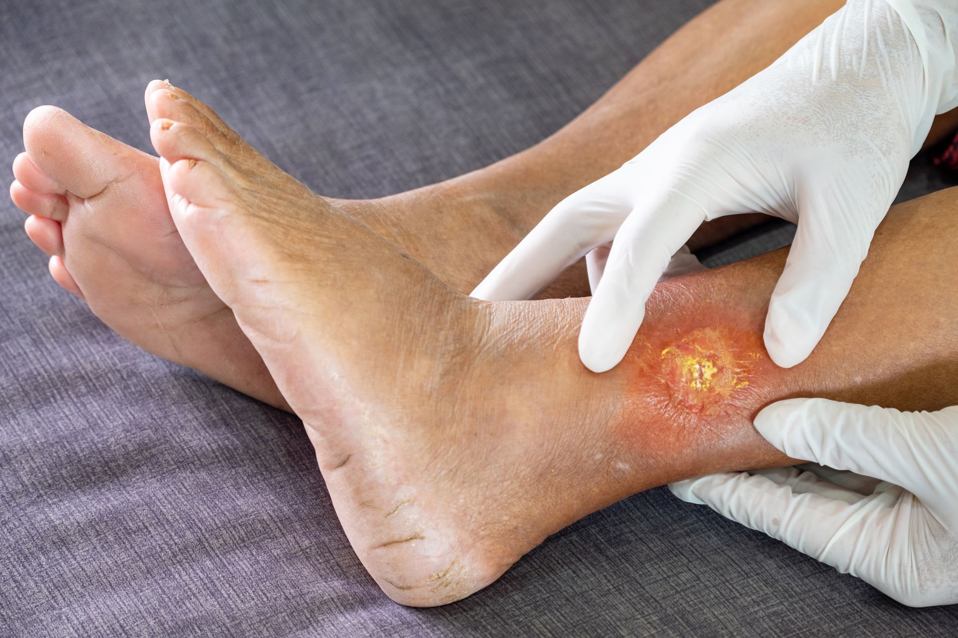 A person's leg with a medical professional's gloved hand examining a wound on the ankle; red skin and infection evident.