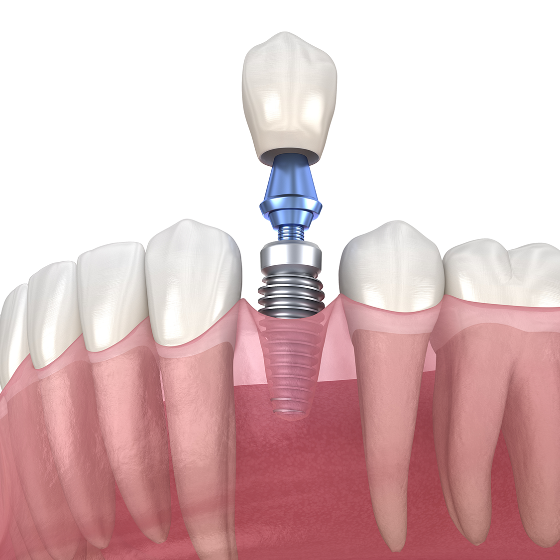 A dental implant is being placed in the middle of a row of teeth.