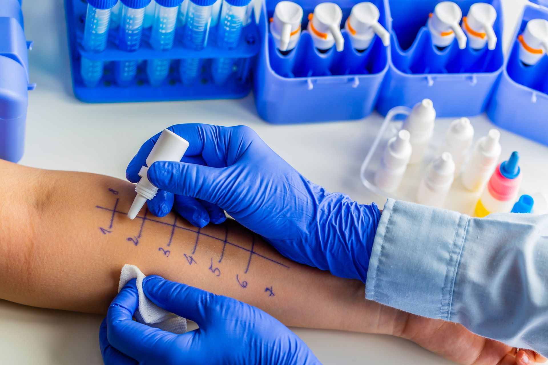 Allergy skin test: a gloved hand applying liquid to arm's numbered test sites.
