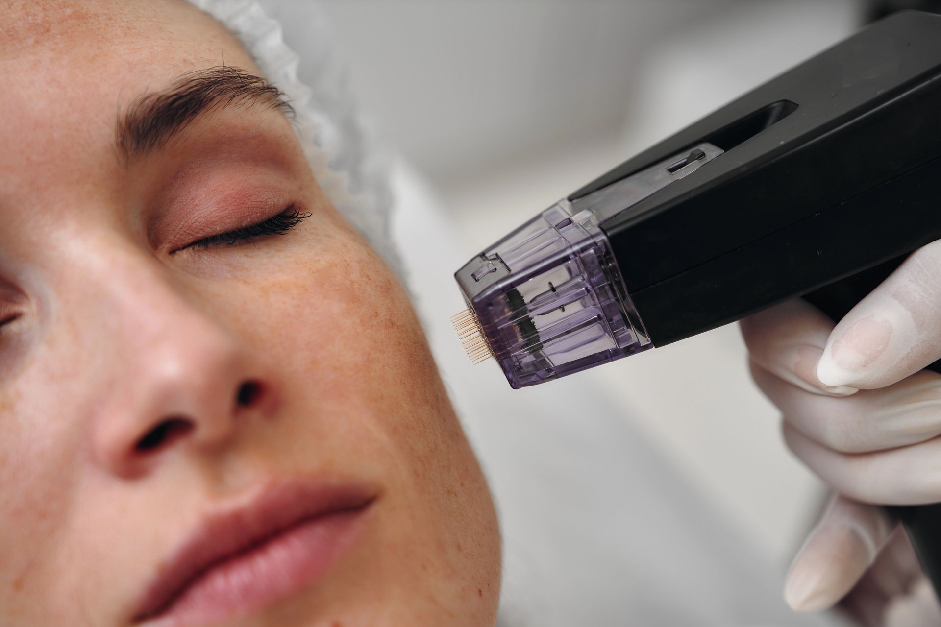 Primer plano del rostro de una persona recibiendo un tratamiento cosmético. Un dispositivo, sostenido por una mano enguantada, se encuentra cerca de la piel.
