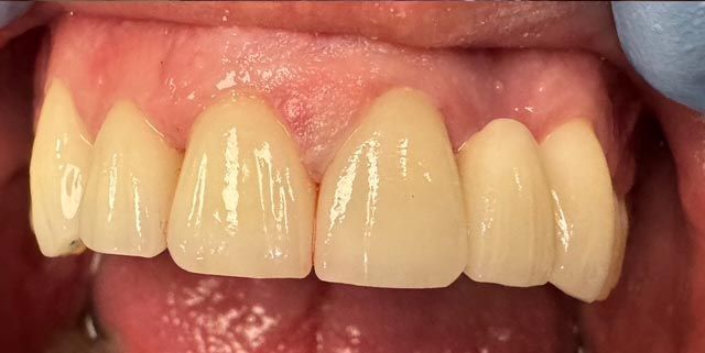 Close-up of upper front teeth with slight discoloration and uneven alignment.