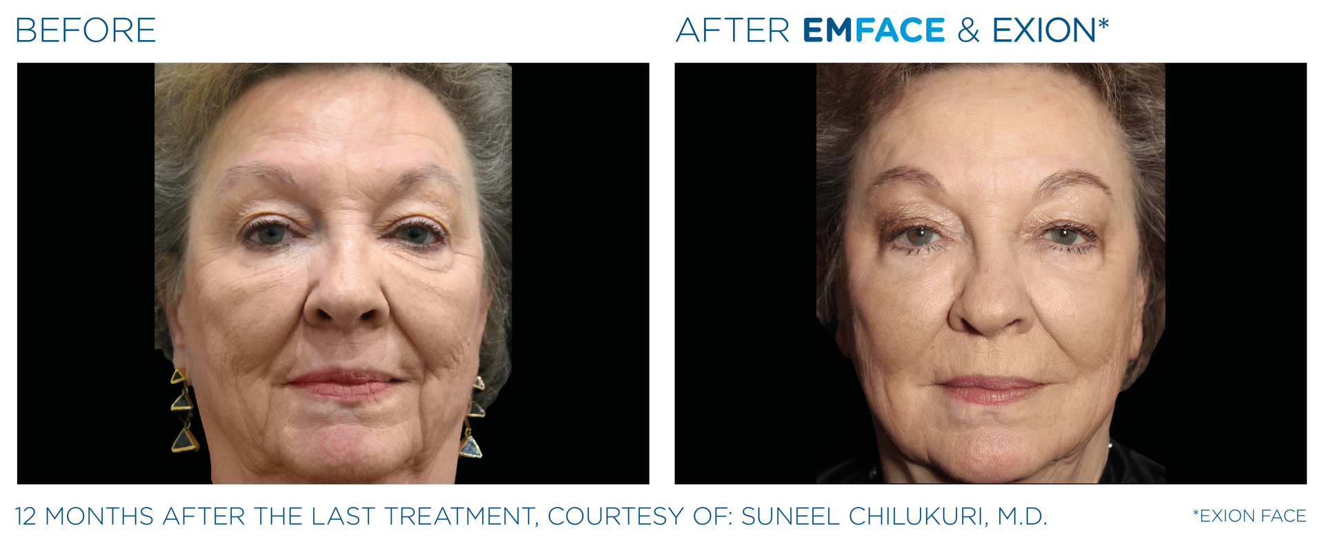 A before and after photo of an older woman 's face.
