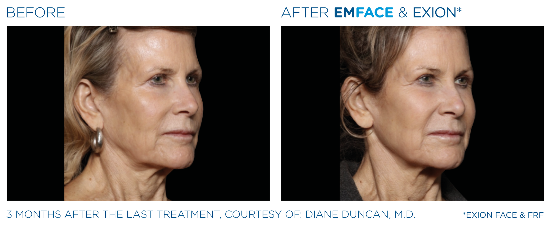 A before and after photo of a woman 's face.