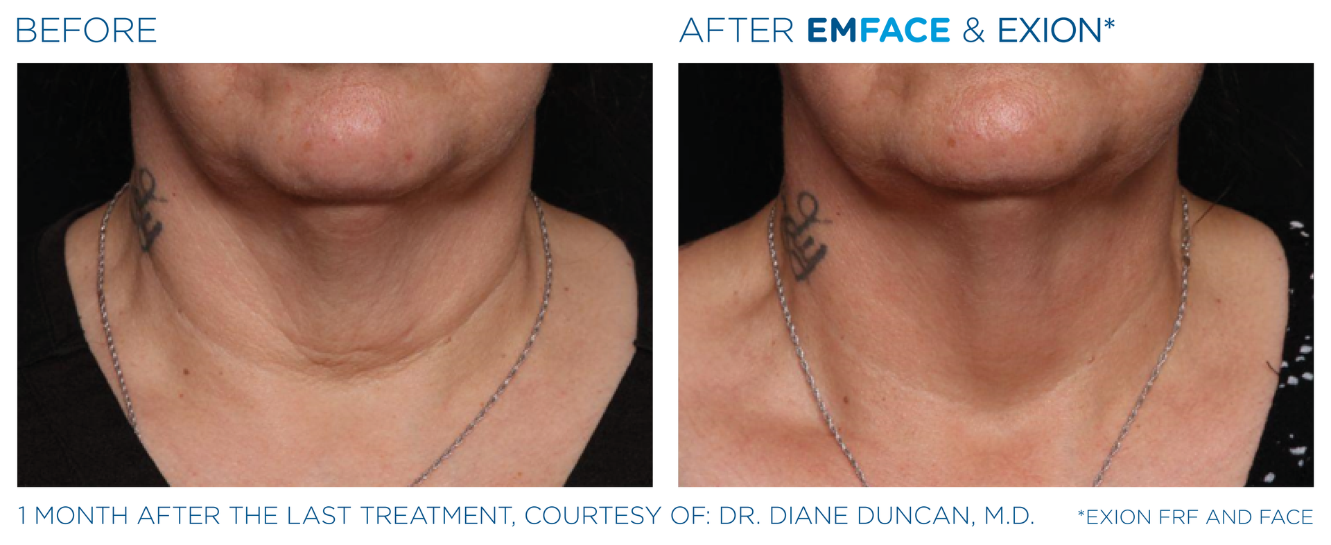 A before and after photo of a woman 's neck and neckline.