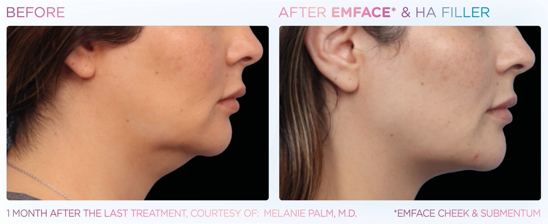 A before and after photo of a woman 's face.