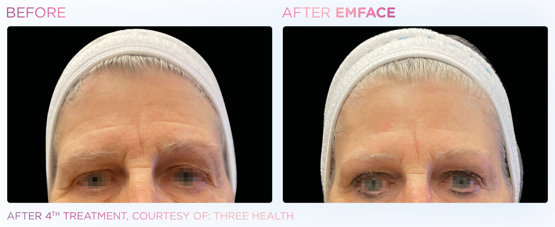 A before and after photo of a woman 's forehead.
