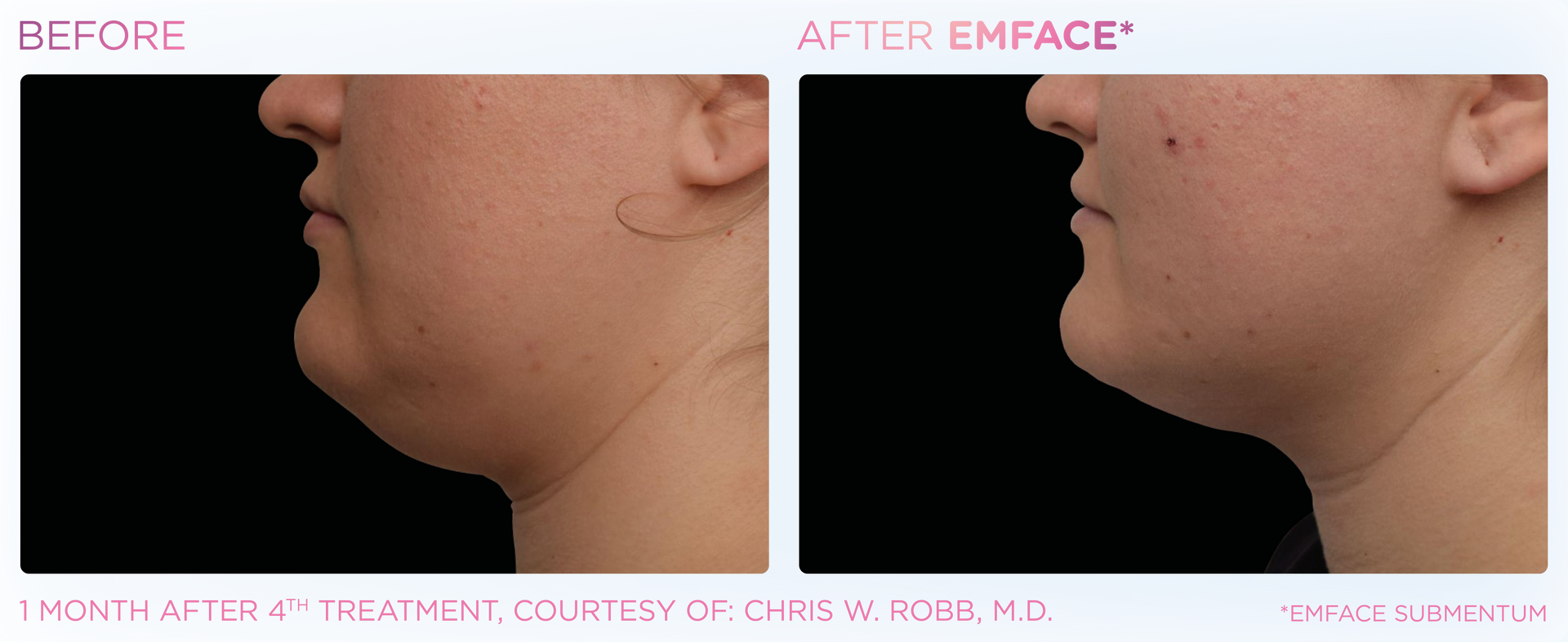 A before and after photo of a woman 's neck and chin.