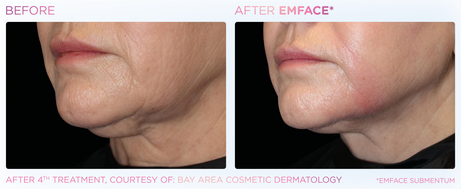 A before and after photo of a woman 's face.