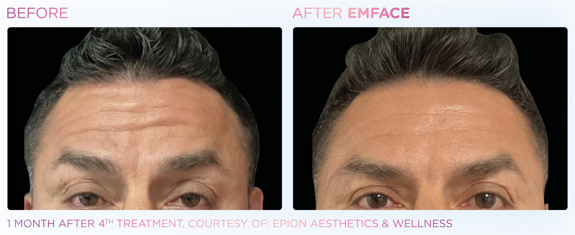 A before and after photo of a man 's forehead.