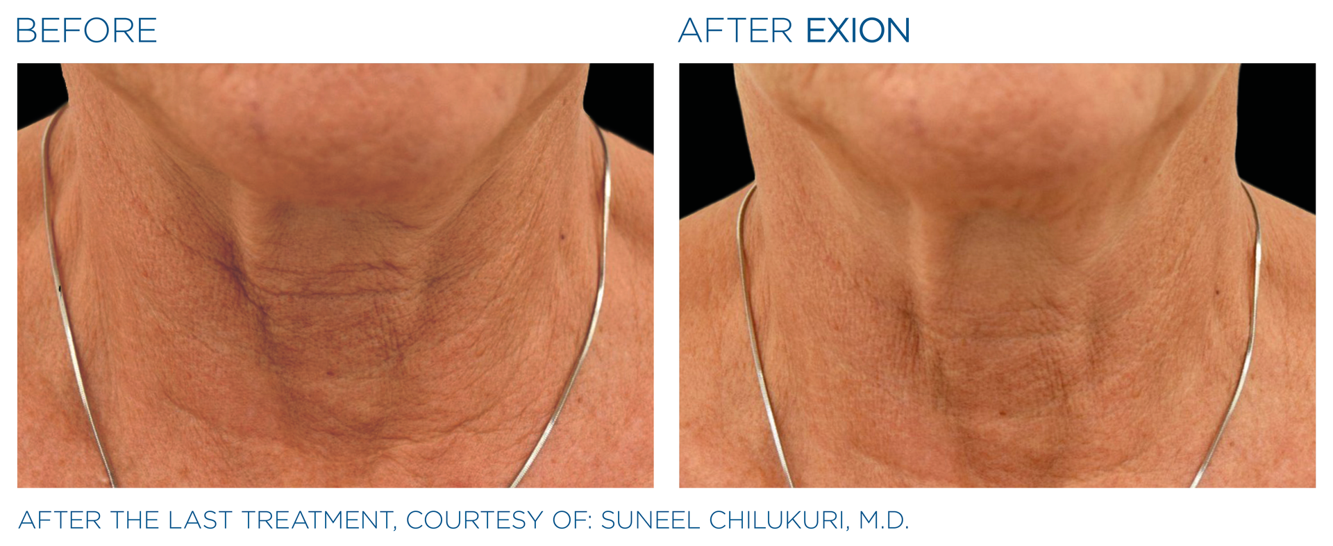 Two pictures of a woman 's neck before and after exon treatment