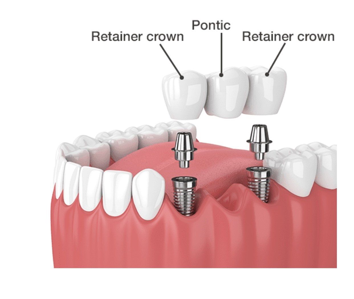 Multiple Teeth Dental Implant — Pittsburgh, PA — Pittsburgh Dental Spa Multiple Teeth Dental Implants — Pittsburgh, PA — Pittsburgh Dental Spa