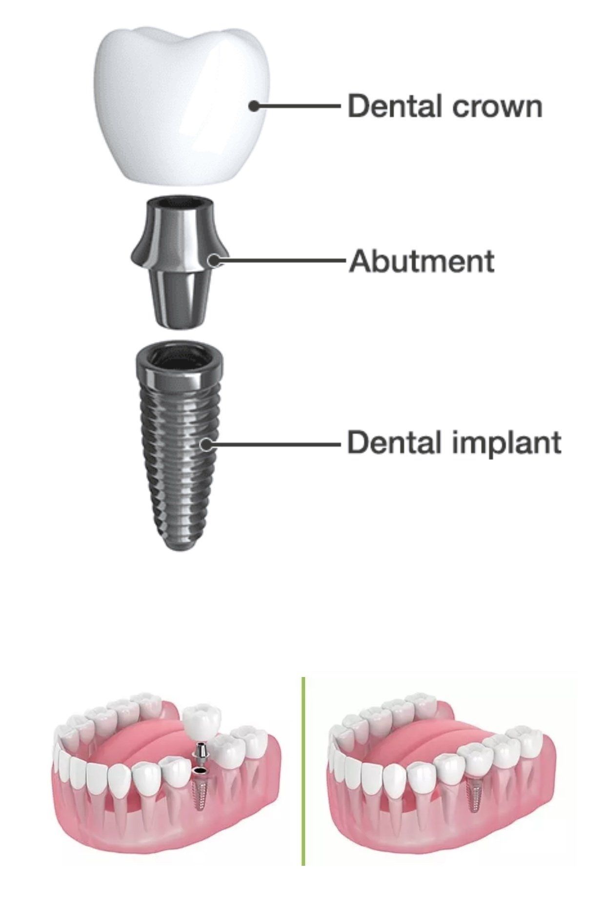 One Tooth Dental Implant — Pittsburgh, PA — Pittsburgh Dental Spa One Tooth Dental Implants — Pittsburgh, PA — Pittsburgh Dental Spa