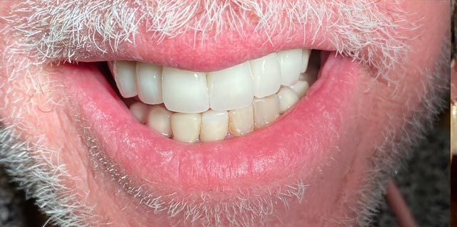 Close-up of a smiling mouth with white teeth and pink lips, showing a gray beard