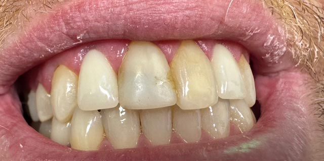 Close-up of a mouth with slightly discolored front teeth and braces visible on the lower teeth