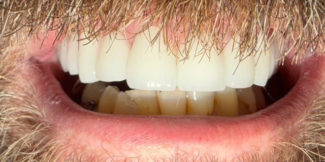 Close-up of a smiling mouth with white teeth, mustache, and beard stubble