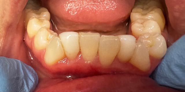 Close-up of lower teeth and gums with yellow buildup near the molars