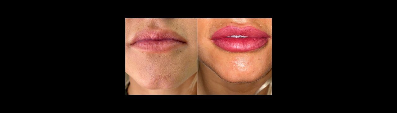 Lips before and after lip filler injections; fuller, pink lips on the right.