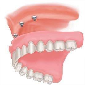 Snap On Denture — Pittsburgh, PA — Pittsburgh Dental Spa Snap On Denture Dental Implants — Pittsburgh, PA — Pittsburgh Dental Spa