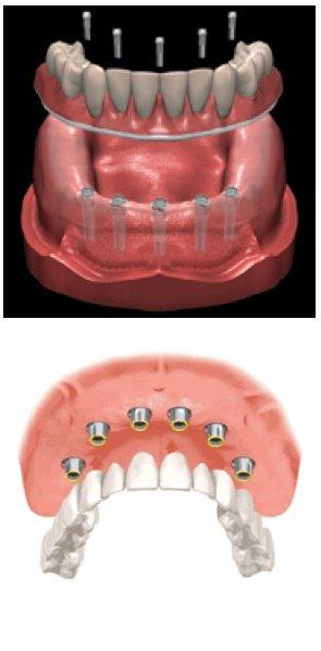 Dental Implants — Pittsburgh, PA — Pittsburgh Dental Spa Dental Implants — Pittsburgh, PA — Pittsburgh Dental Spa