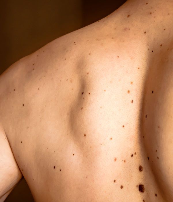 Close-up of a bare upper back with several dark moles on light skin.