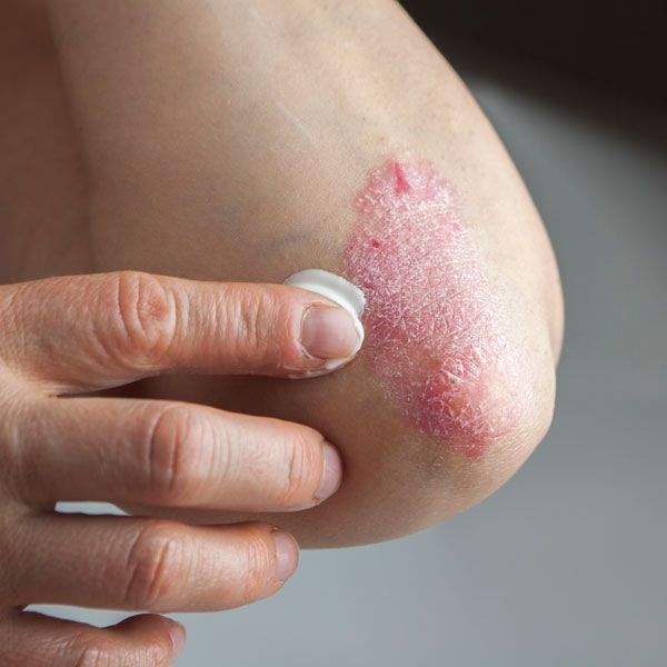 A hand applying cream to a red, scaly patch on an elbow.
