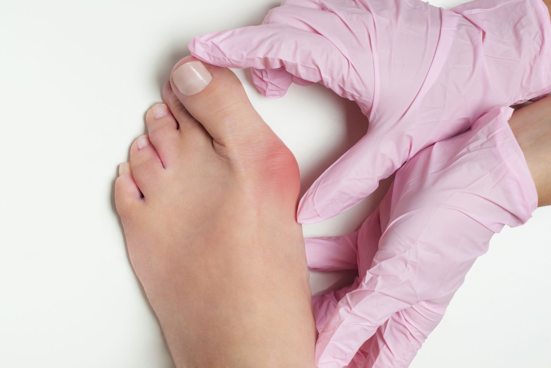Gloved hands examining a red, irritated toe on a foot against a white background
