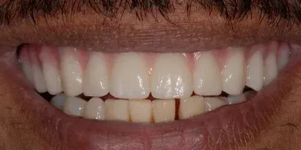 A close-up of a person's smiling mouth revealing bright, white teeth with healthy gums.