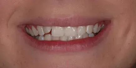 Close-up of a smiling mouth with bright white teeth, one tooth appears chipped.