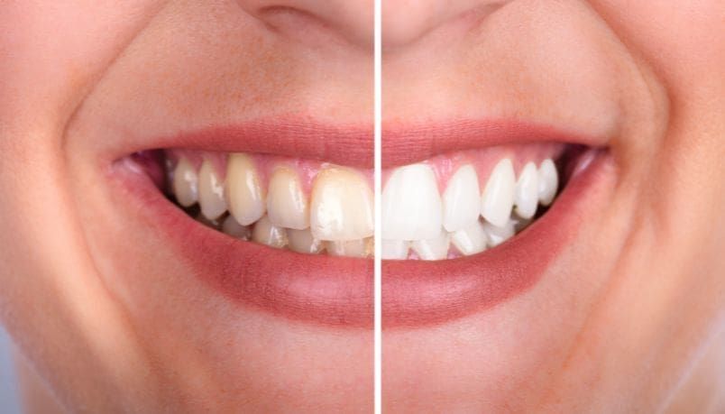 Side-by-side comparison: yellow teeth (left) and white, bright teeth (right) in a smiling mouth.