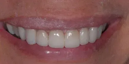 Close-up of a smiling mouth showing a set of white, even teeth and pink lips.