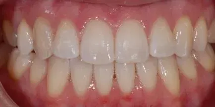 Close-up of healthy human teeth, showing complete set with natural color and healthy gums.