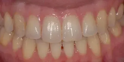 Close-up of a person's teeth. White teeth are visible, set against pink gums.