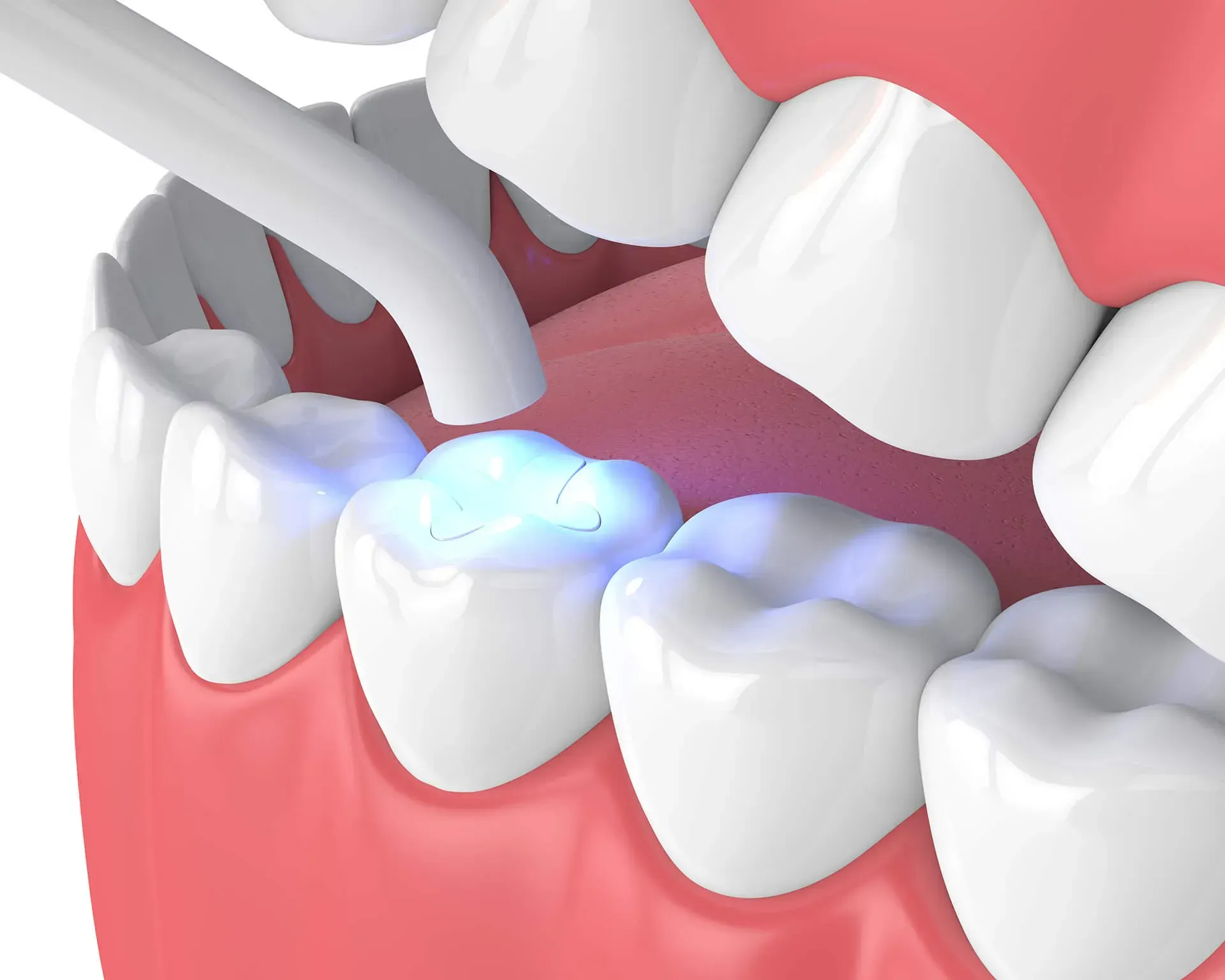 dental sealants oralndo fl