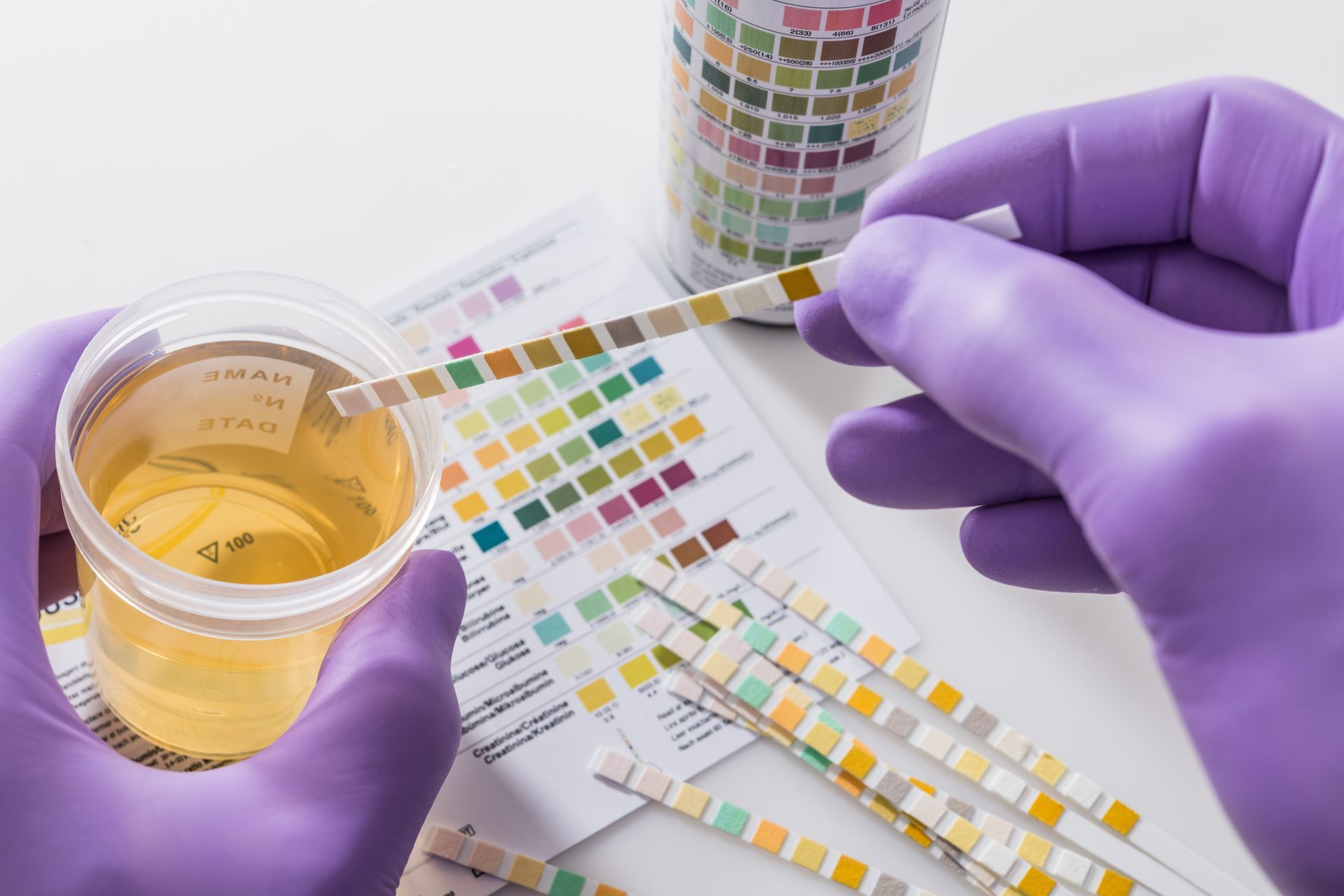 Gloved hand holding a urine sample labeled 