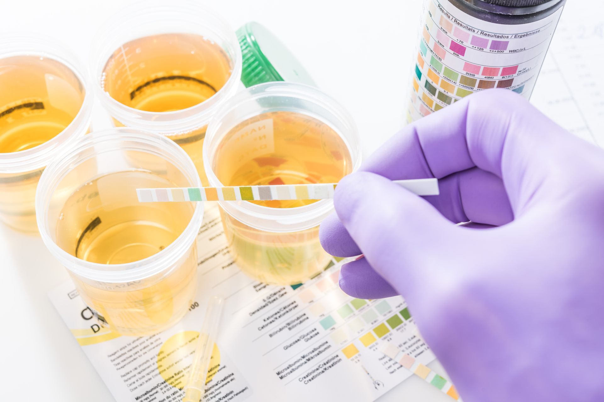 Gloved hand holding a urine sample labeled 