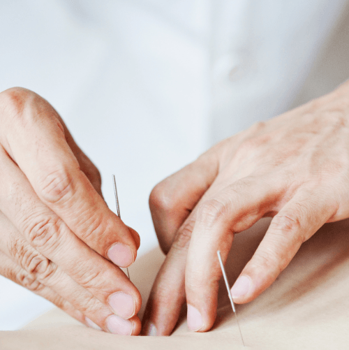Hands guiding acupuncture needles into skin during a naturopathic treatment session