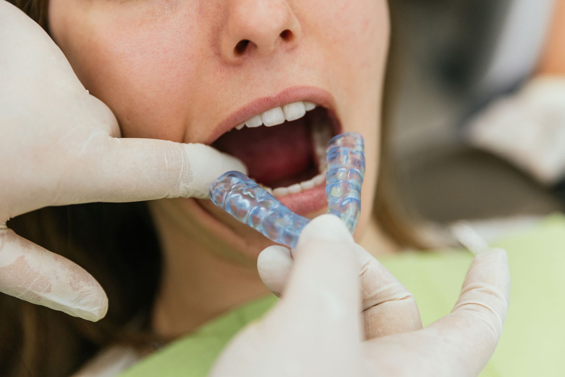 Un dentista applica un paradenti trasparente nella bocca di un paziente. I guanti sono visibili, l'ambiente sembra quello di uno studio dentistico.