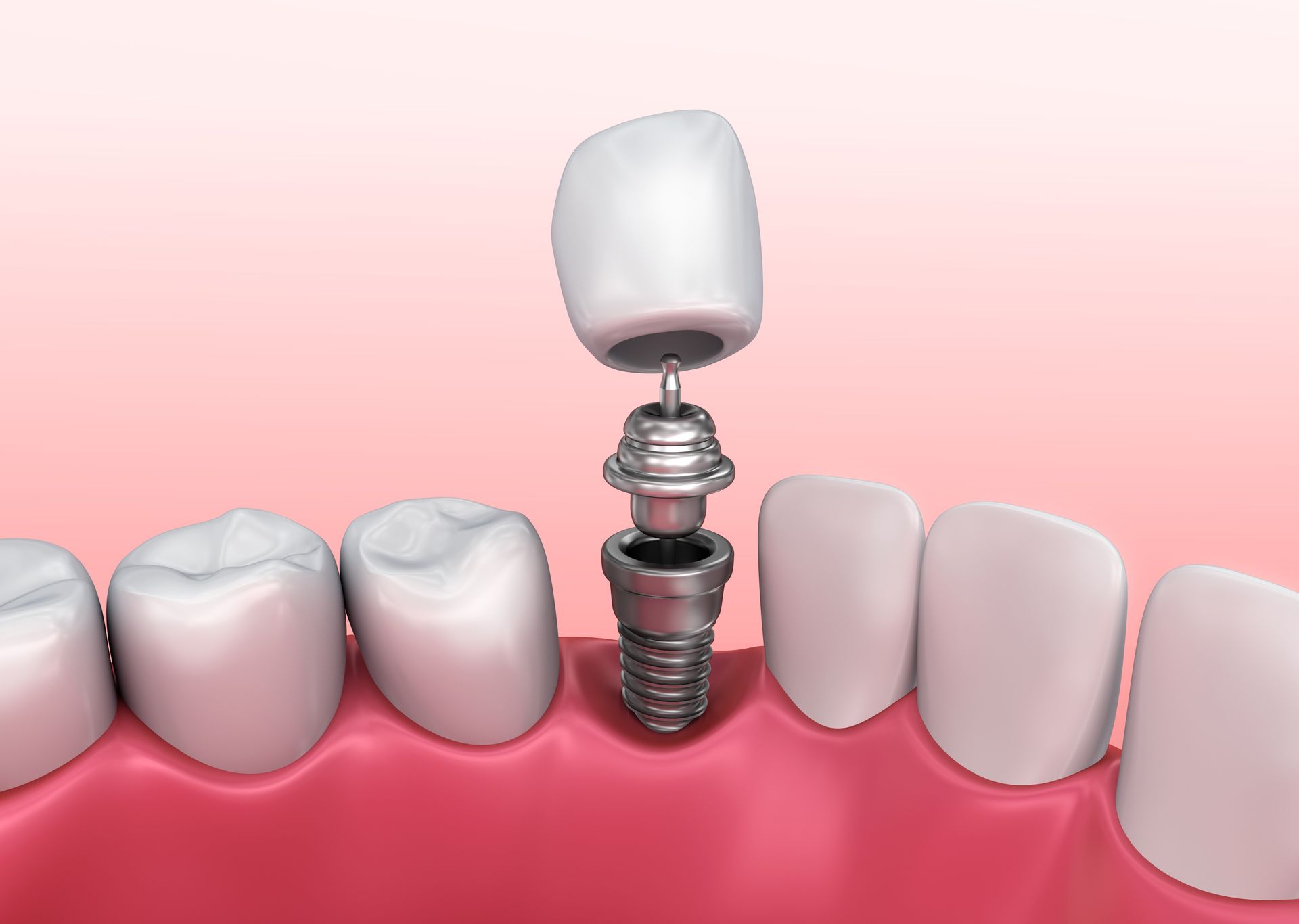 Impianto dentale per implantologia a Torino